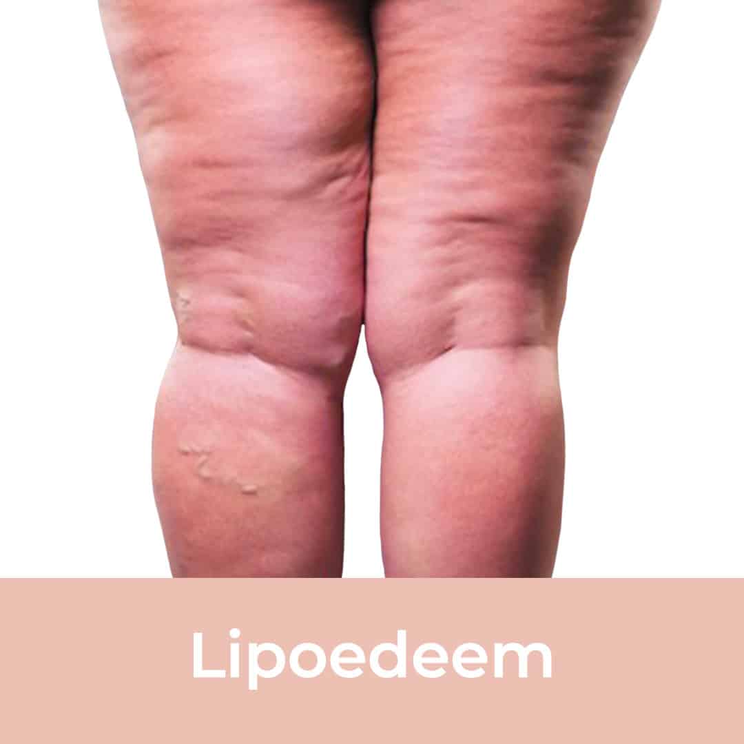 Women with lipedema have major health problems but wait decades