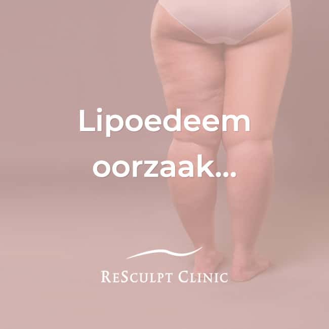 Lipedema: Abnormal female fat that just won't go away Overview